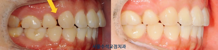  교정치료후 공간이 벌어졌어요