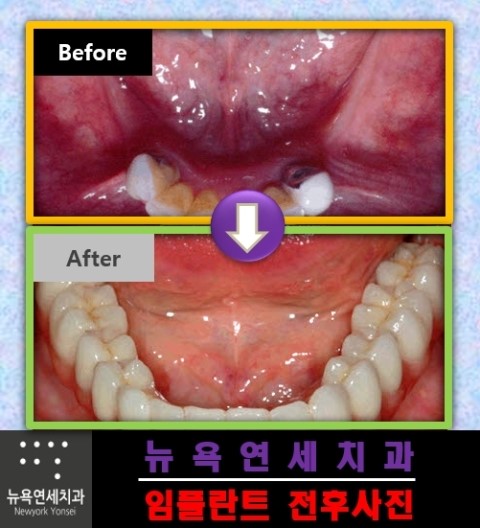  무치악임플란트,틀니임플란트,임플란트틀니비용,무치악임플란트수술