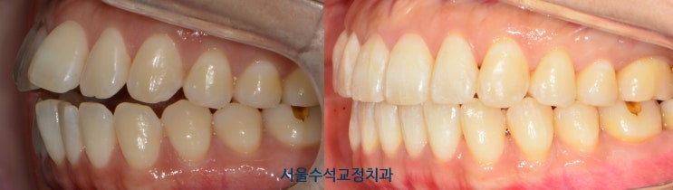  돌출과 개방교합