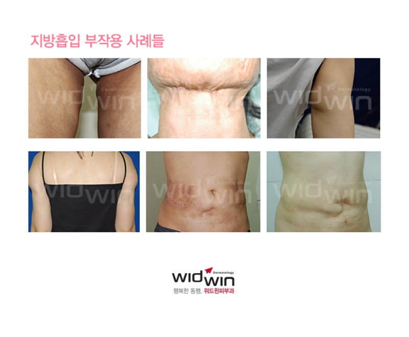 [강남지방흡입 부작용 복부지방흡입유착 강남다이어트클리닉] 이오팻주사 10