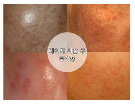 After solving the side effects of charged laser, you can get a refreshing result 6