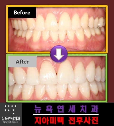  치아미백효과,앞니미백잘하는곳,치아미백병원,치아미백사진