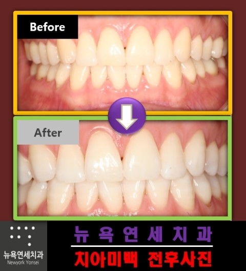 치아미백효과,앞니미백잘하는곳,치아미백병원,치아미백사진