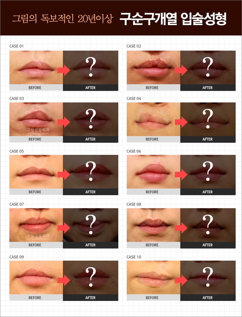 구순구개열 2차수술 궁금해요? : 네이버 블로그, image size:800x1046