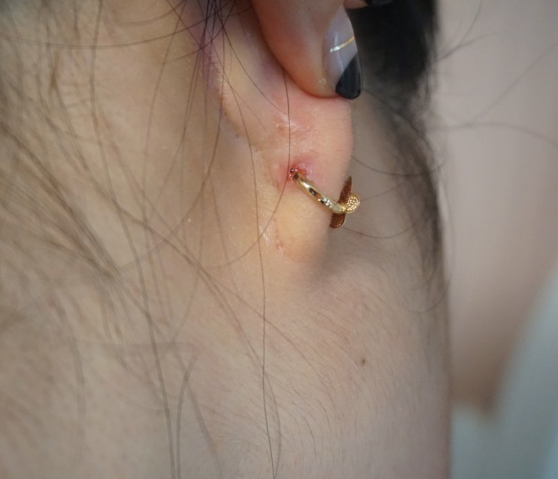 귀 뚫고 염증 생기면 관리는 어떻게? : 네이버 블로그