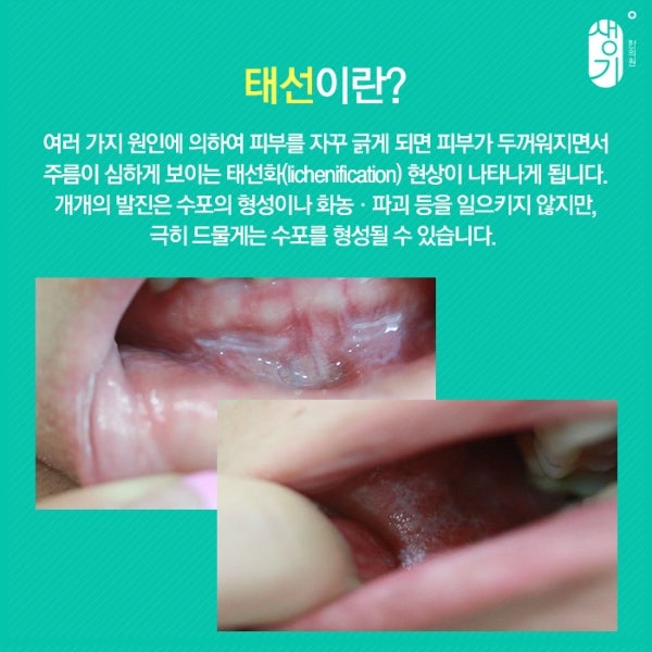 태선이란? (태선화 / 태선 치료 수기) 4
