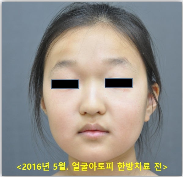 피부지랄, 원인불명 얼굴 알러지 3