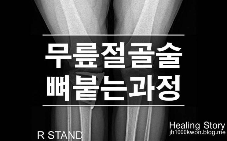 무릎절골술 후 뼈붙는 (골유합) 과정