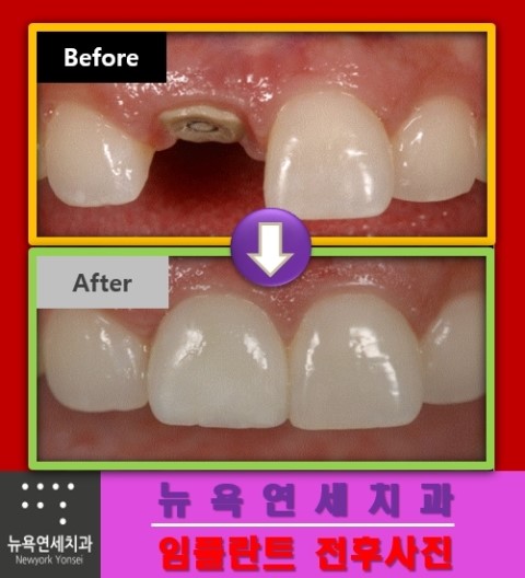  ##임플란트기간,즉시임플란트,당일임플란트,임플란트수술방법##