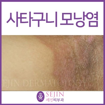 모낭염 치료 관리 설명 가이드