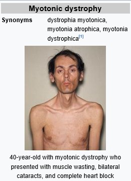 Myotonic dystrophy : 네이버 블로그