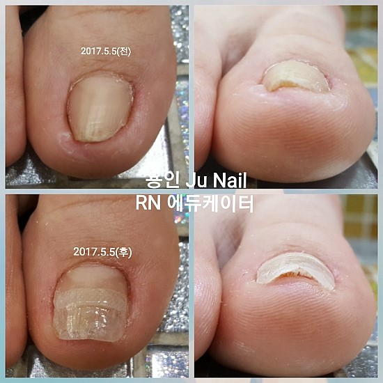 파고드는발톱 단1회 관리/분당용인수원수지보정죽전동/주네일 파고드는발톱 단1회 관리/분당용인수원수지보정죽전동/주네일