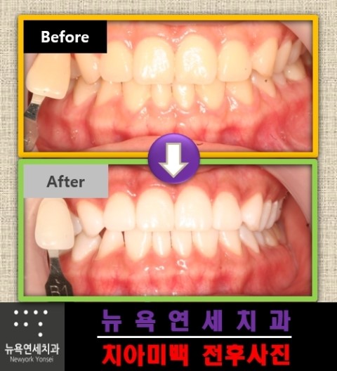 치아미백효과,치아미백종류,치아미백,치아미백방법