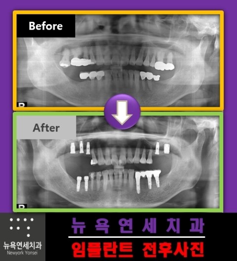  어금니임플란트치료,어금니임플란트,임플란트어금니수술,임플란트수술방법