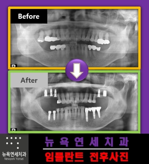 어금니임플란트치료,어금니임플란트,임플란트어금니수술,임플란트수술방법