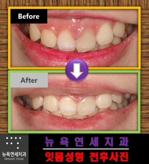  거미스마일잇몸,잇몸성형수술,잇몸성형방법,거미스마일수술
