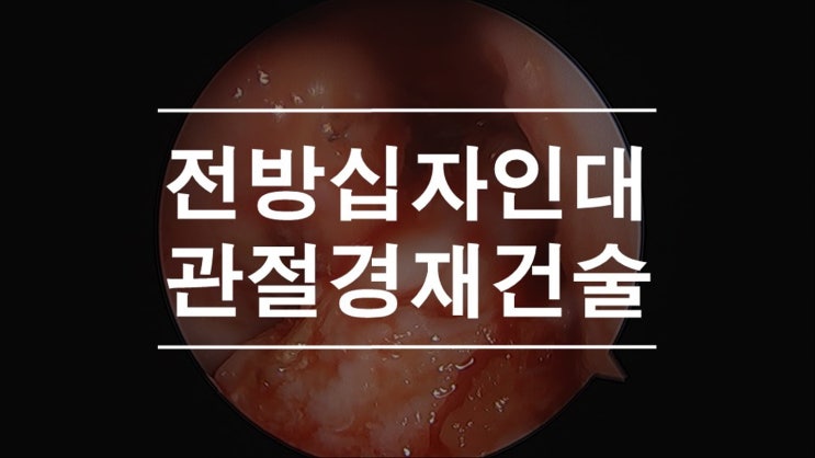  전방 십자인대 파열로 시행한 관절경적 타가건재건술