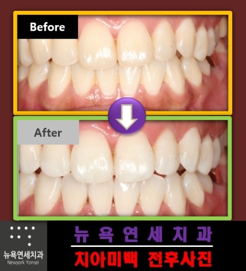  치아미백종류,미백가격,치아미백비용,전문가미백방법