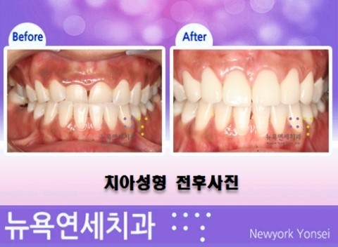  ##라미네이트시술,최소삭제라미네이트,라미네이트방법,라미네이트치료##