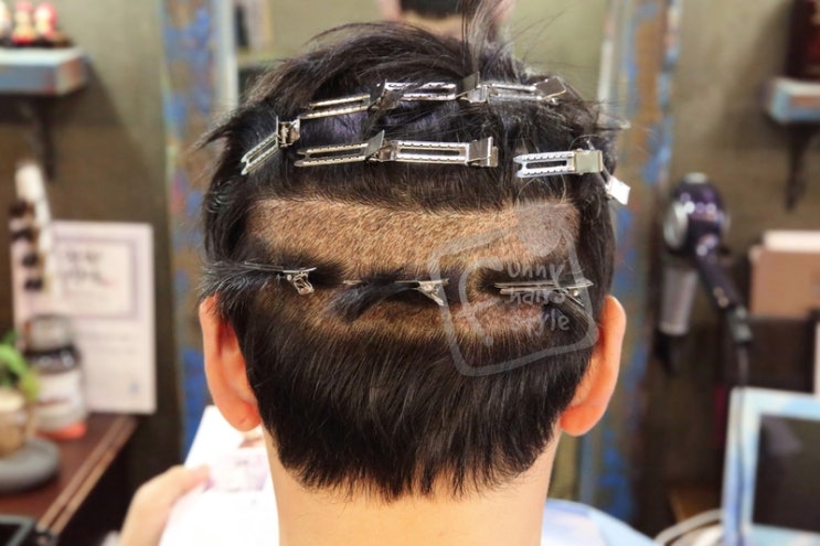  비절개 모발이식수술 암흑기 후두부 정품 퍼니M 테이프 스티커 붙임머리