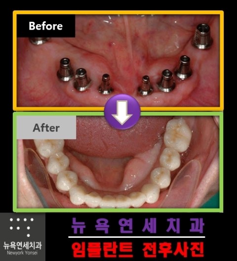  ##틀니임플란트,전체임플란트,무치악임플란트,임플란트틀니##