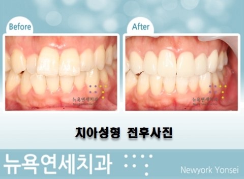  앞니교정치과,앞니교정시술,앞니교정치료,앞니성형병원