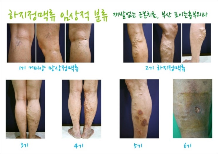 전주하지정맥 만성정맥부전이 진행되었다는 증상