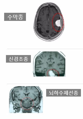뇌종양의 종류 (neuros.net) : 네이버 블로그
