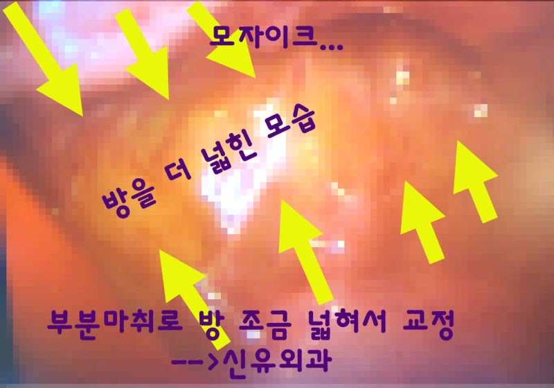 부분마취로 가슴보형물교체하고 방도 교정하고 이중피막도 제거