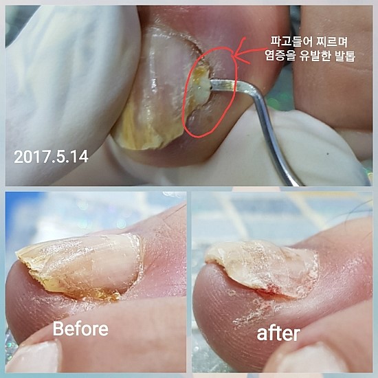 염증발톱/분당용인수원수지보정죽전동/주네일/파고드는발톱 염증발톱/분당용인수원수지보정죽전동/주네일/파고드는발톱