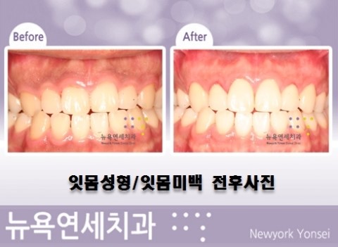  ##잇몸미백치과,잇몸성형방법,검은잇몸,잇몸시술##