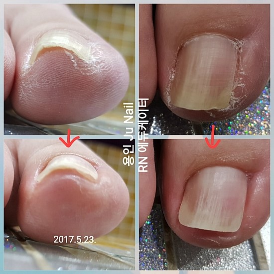 뒤틀린발톱/분당용인수원수지보정죽전동/주네일/파고드는발톱 뒤틀린발톱/분당용인수원수지보정죽전동/주네일/파고드는발톱