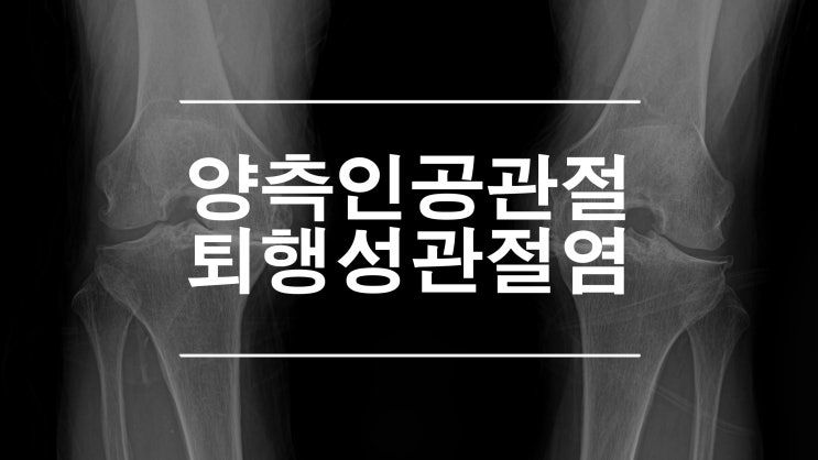  양측 인공관절 퇴행성관절염의 치료 방법