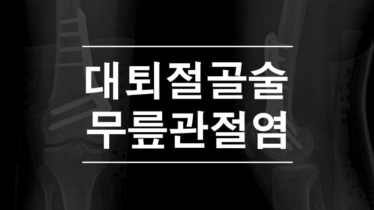  대퇴절골술이란 무릎절골술을 이용한 무릎통증치료