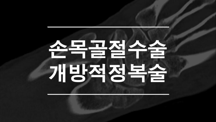  손목골절 개방적정복술 및 내고정술 (Open Reduction & Internal Fixation)