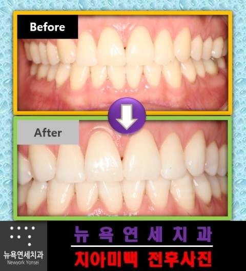  치아미백치료병원,치아미백병원,앞니미백시술,전문가치아미백