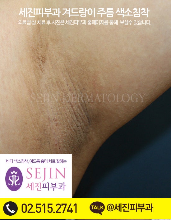 겨드랑이 겨드랑이