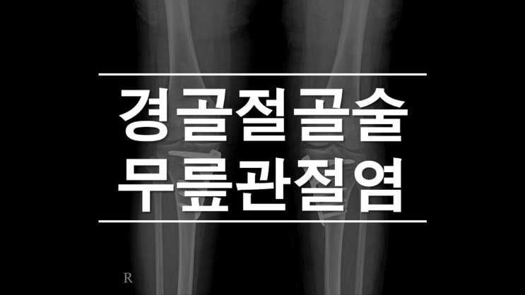 근위경골절골술 무릎관절염 진행을 막는 방법(HTO)