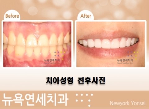  라미네이트앞니성형,라미네이트시술,앞니라미네이트성형,라미네이트치아교정