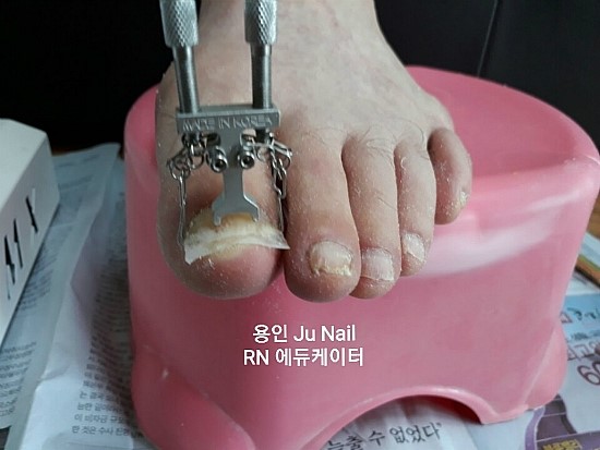 아빠의발톱/분당용인수원수지보정죽전동/주네일/파고드는발톱 아빠의발톱/분당용인수원수지보정죽전동/주네일/파고드는발톱