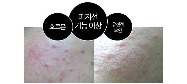여드름연고 자국까지 연해진법!