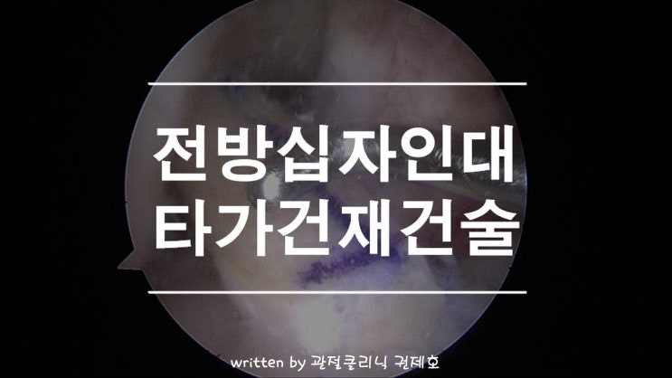 전방십자인대파열 타가건재건술 무릎동요로 인한 이차손상 예방(ACL allograft reconstruction)