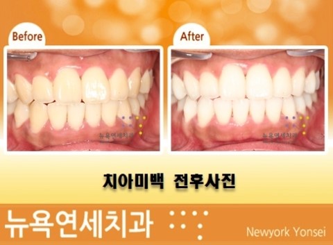  전문가치아미백,앞니미백가격,치과미백,치아미백치과