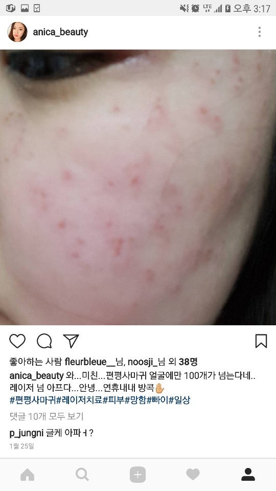 편평 사마귀를 제거하는 방법, 얼굴의 사마귀는 레이저로 할 수 없습니다. 2