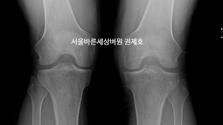 [독산동정형외과] 휜다리 있는 경우 근위 경골 절골술을 필요한 이유는?서울바른세상병원 권제호
