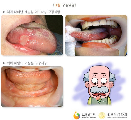 설침알보 바를때마다 통증으로 힘들때 설침약 구내염약 연고패치 대처방법 4