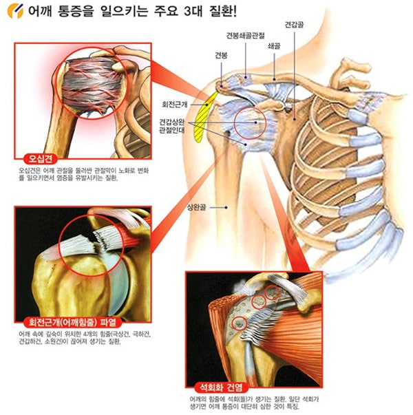 설침알보 바를때마다 통증으로 힘들때 설침약 구내염약 연고패치 대처방법 6