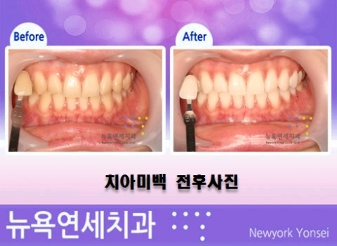 치아미백종류,앞니미백방법,치아미백병원,치아미백전후사진
