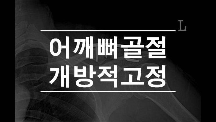 어깨뼈골절 개방적 정복술 내고정술/서울바른세상병원 권제호
