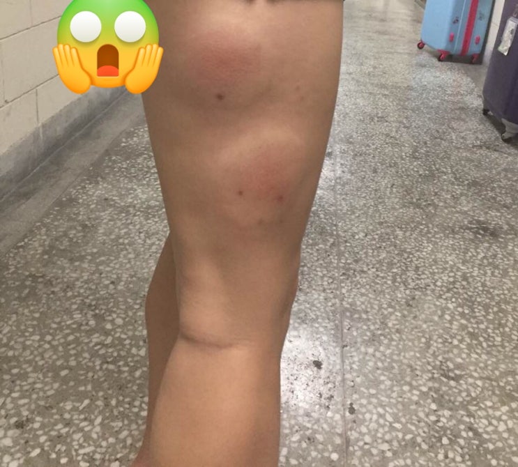  [*대만 교환학생 필독*] ※대만 모기의 무서움※